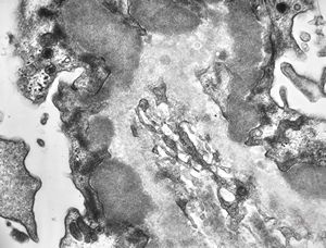 M,53y. | type III membranoproliferative glomerulonephritis M,53y. | type III membranoproliferative glomerulonephritis